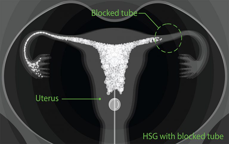 hsg-test-fallopian-tube-testing-kl-fertility-centre